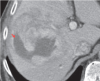 Großer Tumor mit zentraler Nekrose in der Leber-CT