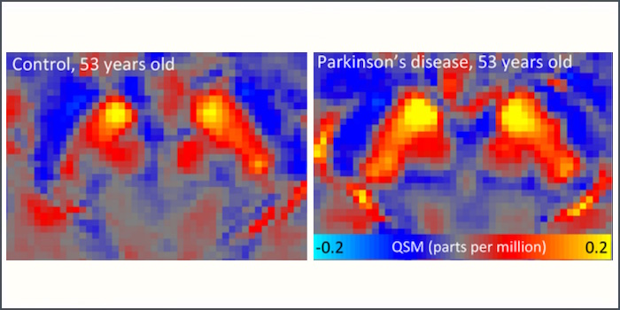 Parkinson: Ungewöhnliche Eisenwerte im Gehirn