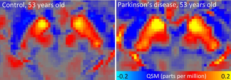 Substantia nigra bei einem gesunden Studienteilnehmer und einem Parkinson-Betroffenen. Ein starkes QSM-Signal (rot und gelb) weist auf hohe Eisenwerte hin. (Quelle: DZNE/Julio Acosta-Cabronero)