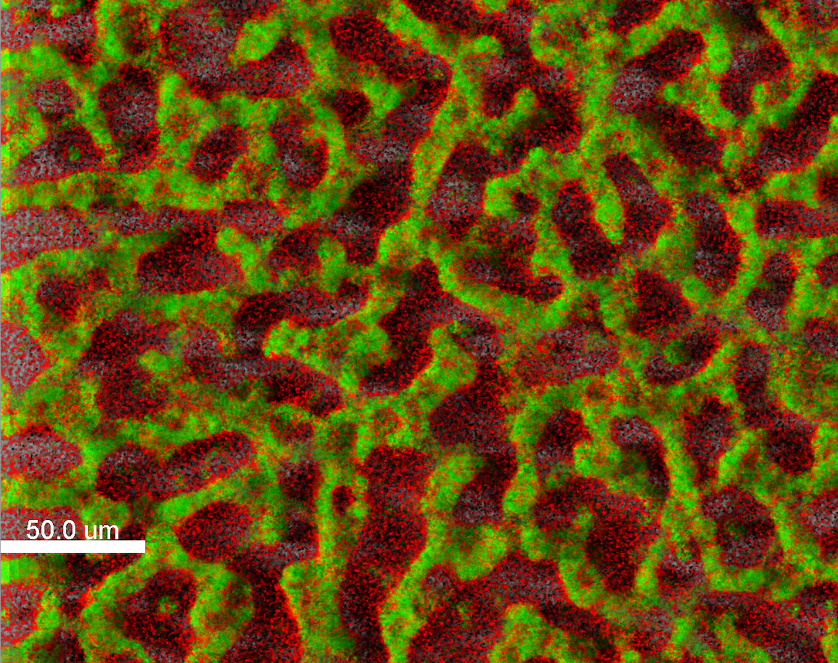 Der Krankenhauskeim Pseudomonas aeruginosa schützt sich in dichten Biofilmen vor Antibiotika und Angriffen des Immunsystems. Grün = lebende Pseudomonas-Zellen; rot = tote Zellen (©TWINCORE/Janne Thöming)