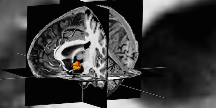 Depression: MRT zeigt vergrößerte Hirnregion zur Stresskontrolle
