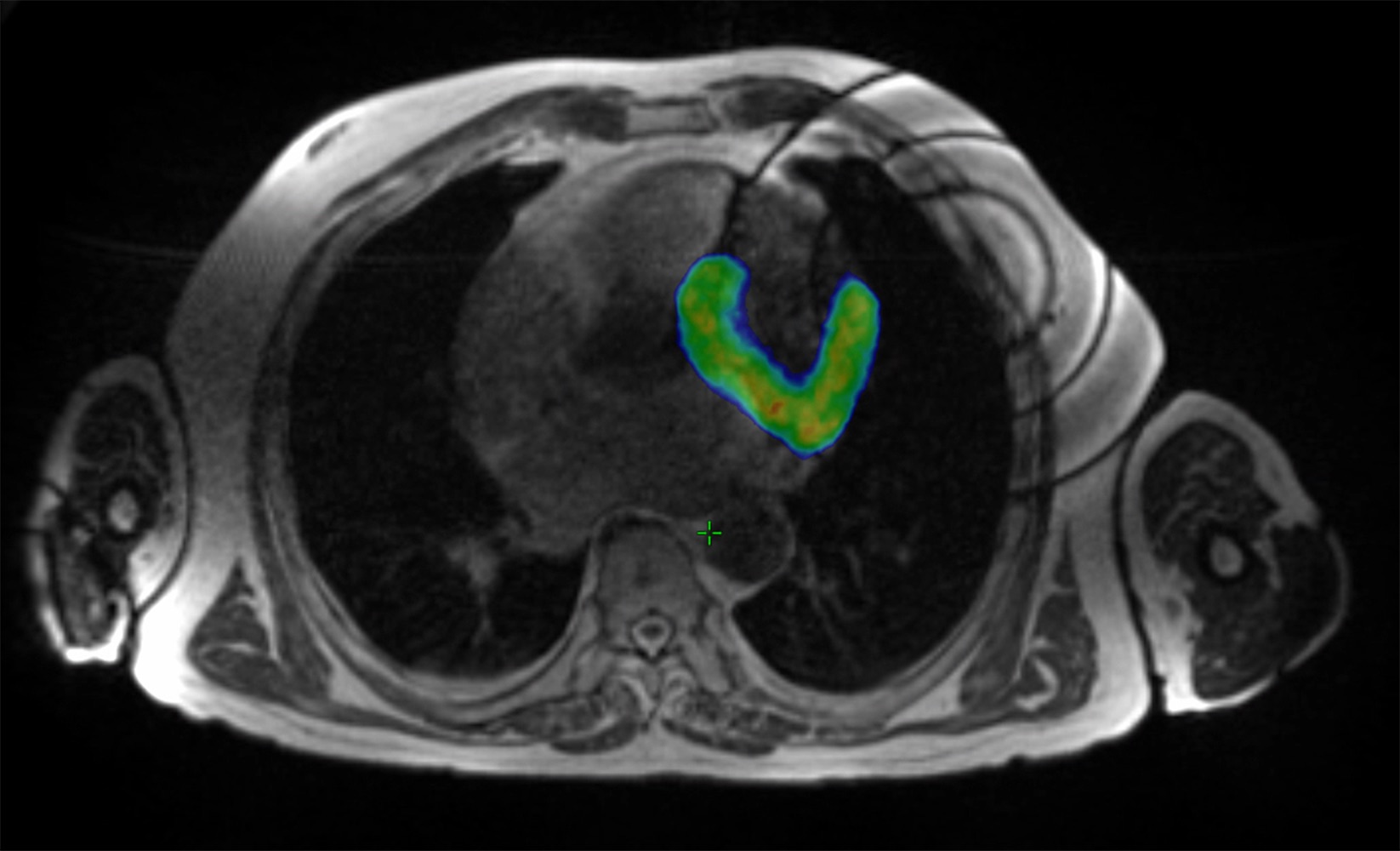Unter MRI Bildgebung wurde der betroffene Anteil des Herzmuskels gezielt bestrahlt (in Farbe). ©Universitätsspital Zürich
