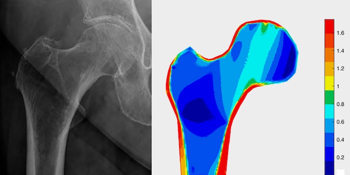 Osteoporose: CT mit Verfahren aus dem Bauwesen kombiniert