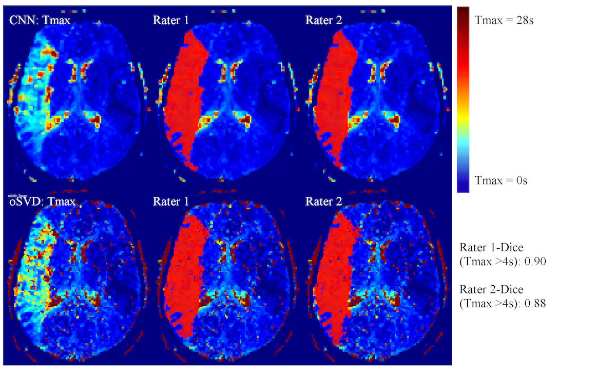 Hirn-Perfusionskarte eines Patienten mit akutem Schlaganfall – oben mit Convolutional Neural Network (CNN) und unten mit der klassischen Methode (©Insel Gruppe)