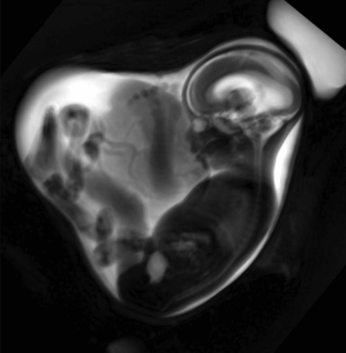 Die fetale MRT kann etwa ab der 18. Schwangerschaftswoche eingesetzt werden (©LMU Klinikum München)