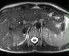 Patientin mit bekanntem Mammakarzinom, Verdacht auf solitäre Lebermetastase im CT und Ultraschall