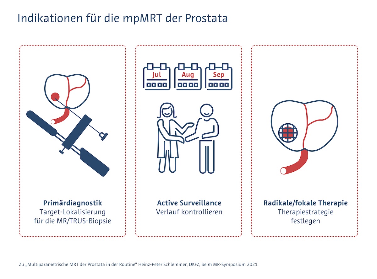 Indikationen für die multiparametrische MRT der Prostata