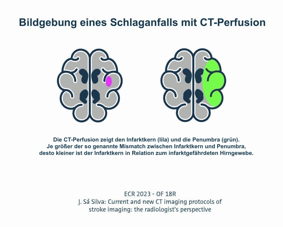 Die CT Perfusion zeigt den Infarktkern (lila) und umgebendes Hirngewebe (grün). Je größer der so genannte Mismatch vom Infarktkern zum Hirngewebe, desto kleiner ist die der Infarktkern relativ zum infarktgefährdeten Hirngewebe.